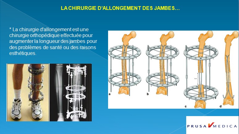 CHIRURGIE D'ALLONGEMENT DES JAMBES | Virtual Clinic